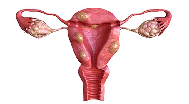 Read more about the article Referat Massa Uterus
