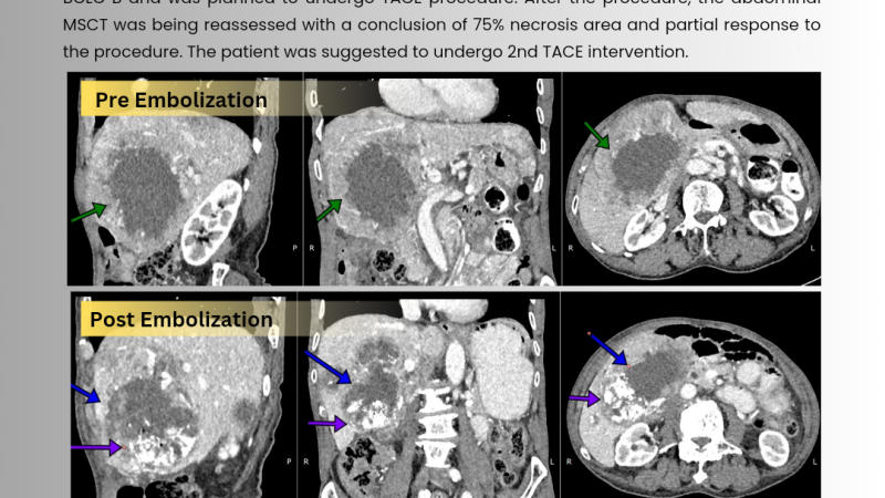 Aikardi_GREAT RESULT TRANSARTERIAL CHEMOEMBOLIZATION iN A PATIENT WITH HEPATOCELLULAR CARCINOMA_Poster Abstract