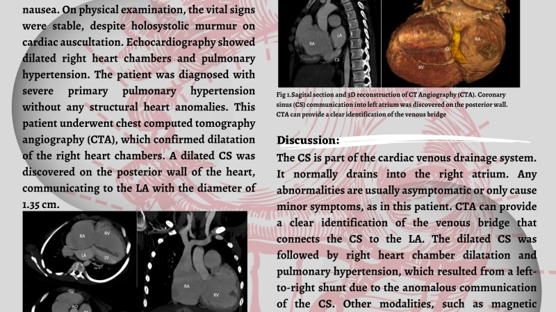 Coronary Sinus Communication Into Left Atrium Focused On CT Finding