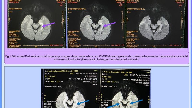IP Sari_3 Tesla (3T) Magnetic Resonance Imaging (MRI) as an Early Detection of Children Seizure- Subtle Imaging Finding Related To Clinical Evaluation_Poster_page-0001 (1)