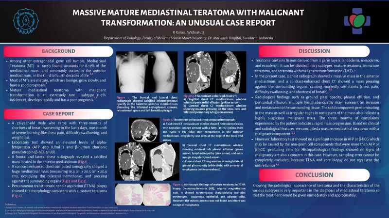 K Kalua , Widiastuti Department of Radiology, Faculty of Medicine Sebelas Maret University, Dr. Moewardi Hospital, Surakarta, Indonesia_page-0001_11zon
