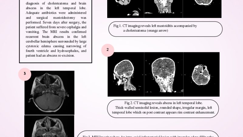 Nahiyah Isnanda_Brain Abscess As A Complication Of Chronic Suppurative Otitis Media And Cholesteatoma In Pediatric A Rare Case_Poster-1_page-0001 (2)