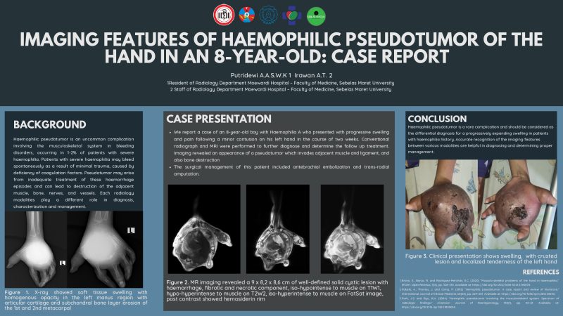 Putridewi AASWK_Eposter_IMAGING FEATURES OF HAEMOPHILIC PSEUDOTUMOR OF THE HAND IN AN 8-YEAR-OLD_page-0001