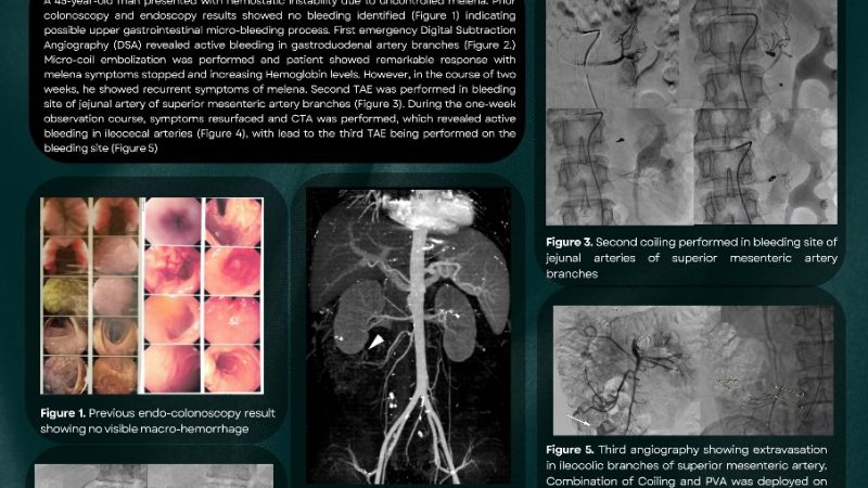 Serial coil embolization