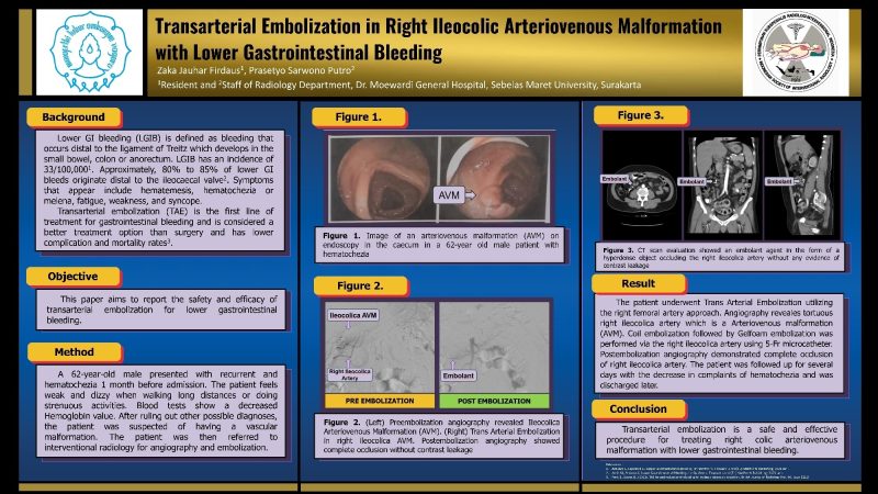 Transarterial Embolization in Right Ileocolic Arteriovenous Malformation with Lower Gastrointestinal Bleeding - Zaka Jauhar Firdaus21724120132235