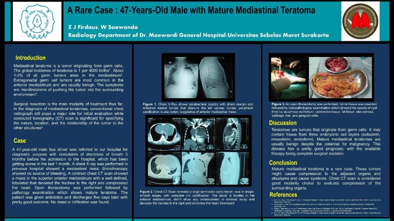Z J Firdaus_A Rare Case 47 Years Old Male with Mature Mediastinal Teratoma